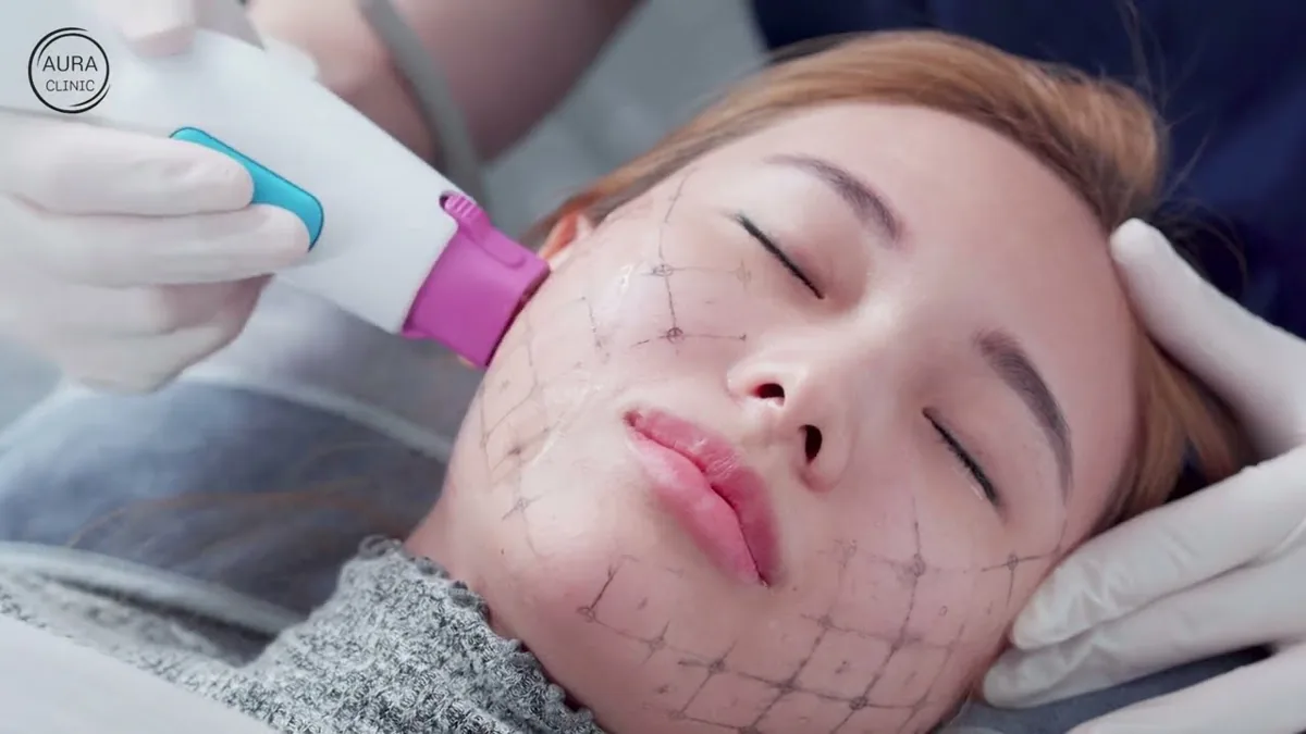 Bác sĩ thực hiện liệu trình trong video sự kiện ra mắt Thermage FLX của Aura